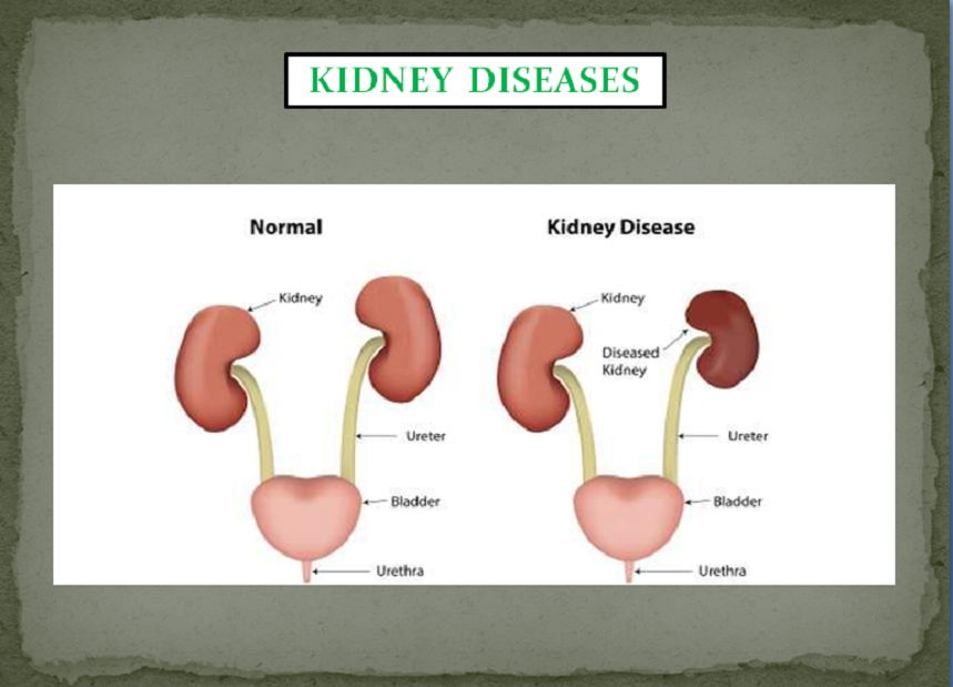 KINDEY INFECTIONS PACKAGE