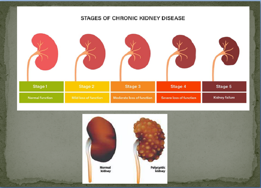 KINDEY INFECTIONS PACKAGE